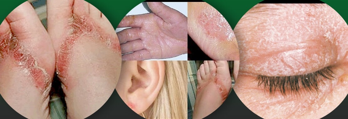 Tipo de alergia 3