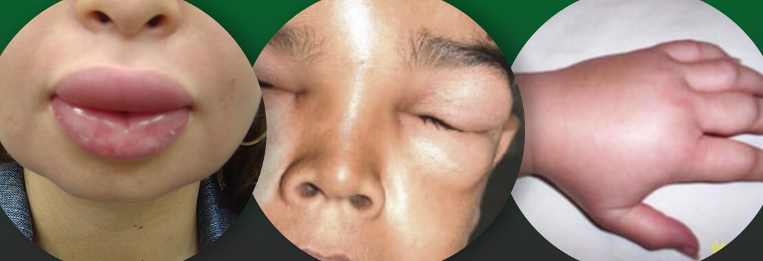 Tipo de alergia 4