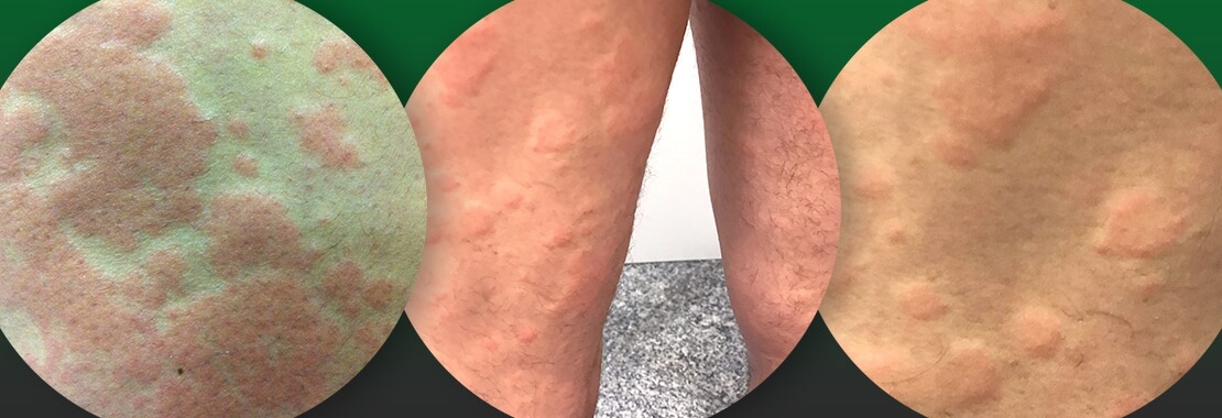 Tipo de alergia 5